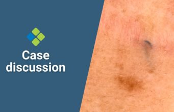 How would you manage this dark area arising in a
scar?