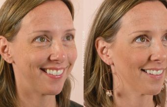 How Chemical Peels Are Used to Treat Sun Damaged
Skin